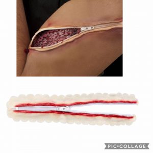 Prosthetic Zipper Wound