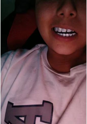 FAKE TEETH - Hip Hop Grills Set SILVER - Image 2